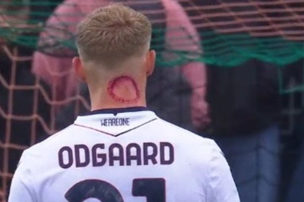 Serie A star insists he ‘wasn’t bitten by a zombie’ as fans spot horror neck injury